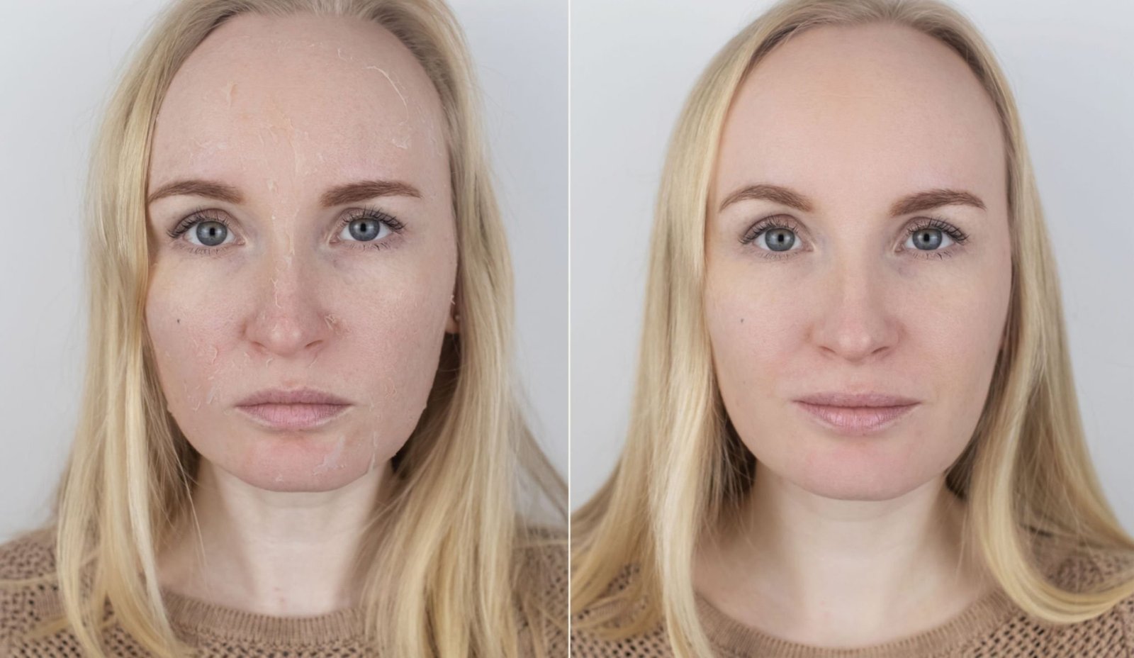 Deep pigmentation treatment, woman before and after treatment chemical peel