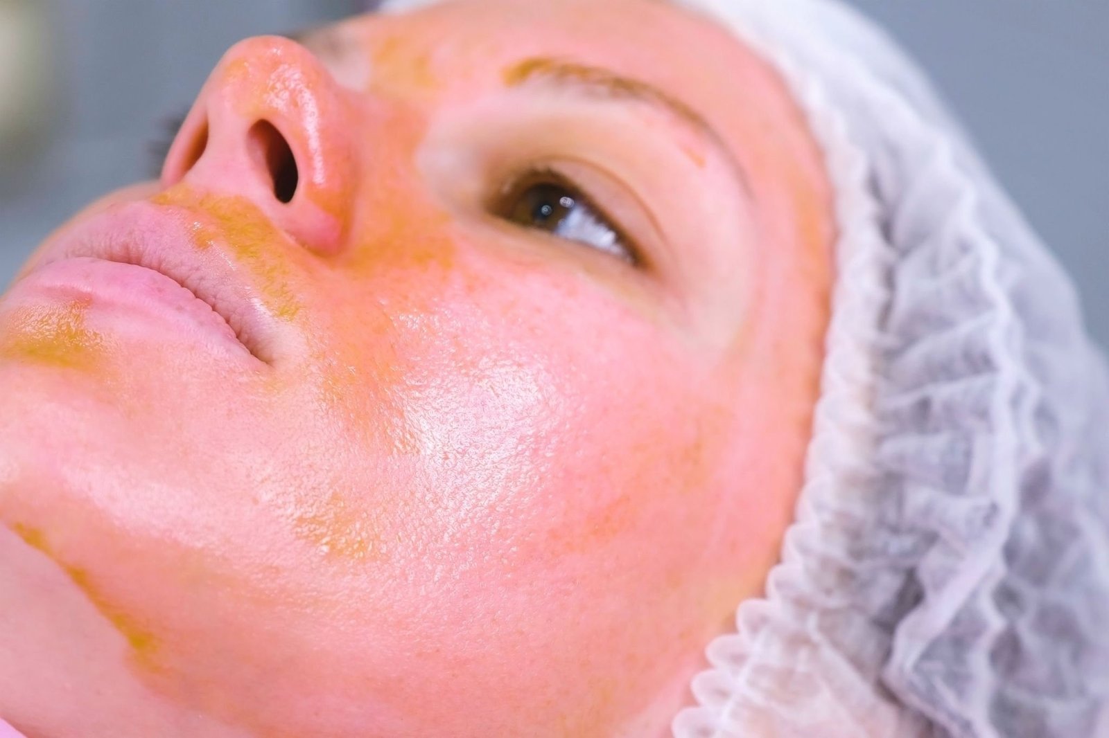 Chemical peel in-progress: professional facial application for skin renewal, radiance, and pigmentation reduction—clinic photo from NewLife Aesthetics, Raynes Park & Wimbledon, London.