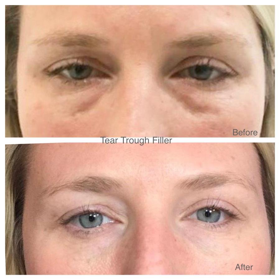 Tear trough filler before and after – non-surgical eye rejuvenation in Wimbledon, Raynes Park by expert practitioners
