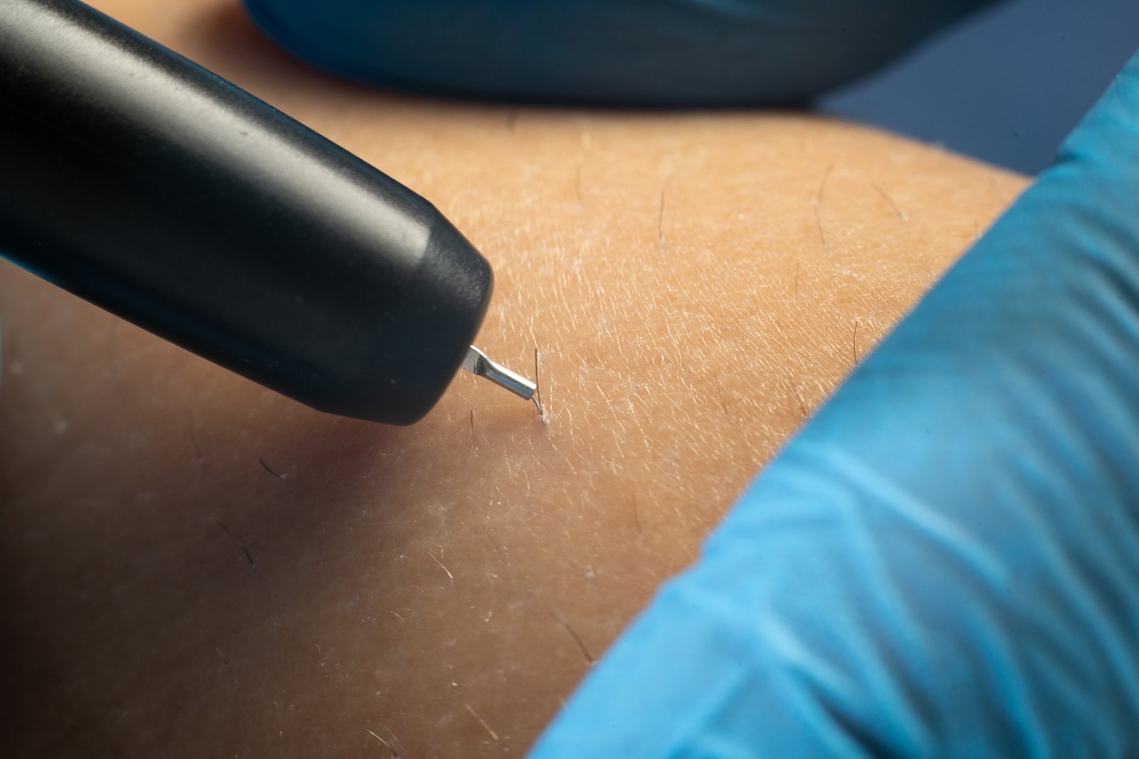 Macro close-up of electrolysis needle for permanent hair removal treatment at NewLife Aesthetics, Raynes Park & Wimbledon, London—precision epilation for smooth skin.