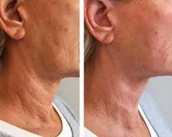 Before and after HIFU neck lift: visible tightening and rejuvenation of loose, sagging neck skin after non-surgical ultrasound treatment at NewLife Aesthetics, Raynes Park & Wimbledon, London.