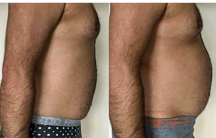 Male abdomen cryolipolysis fat freezing before and after: visible inch loss and improved body contour from non-surgical treatment—gallery photo NewLife Aesthetics, Raynes Park & Wimbledon, London.