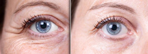 Split image: before and after Global Eyecon under-eye treatment—significant removal of crow’s feet, dark circles, and periocular wrinkles at NewLife Aesthetics, Raynes Park & Wimbledon, London.