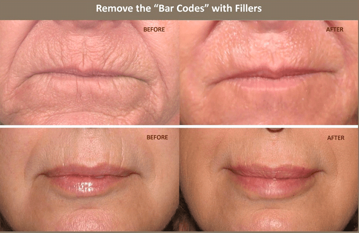 Lip lines (barcode lines) before and after: visible reduction in vertical wrinkles above the lips using hyaluronic acid filler at NewLife Aesthetics, Raynes Park & Wimbledon, London.