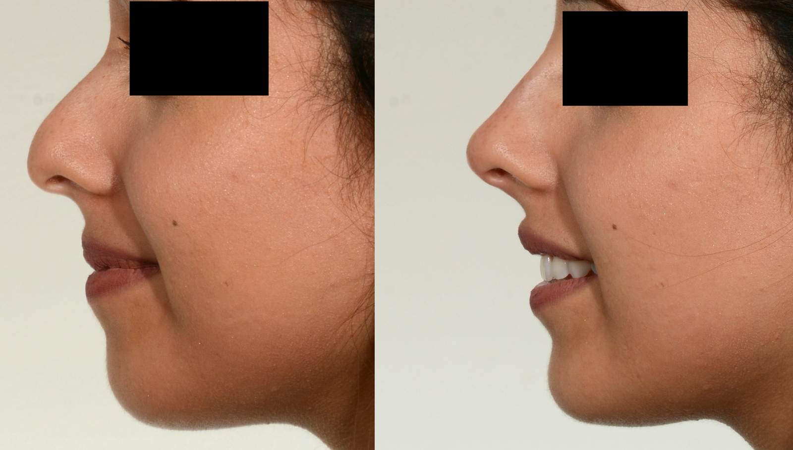 Non-surgical rhinoplasty before and after: profile view of nose reshaping with dermal filler for a straighter, more refined nose bridge at NewLife Aesthetics, Raynes Park & Wimbledon, London.