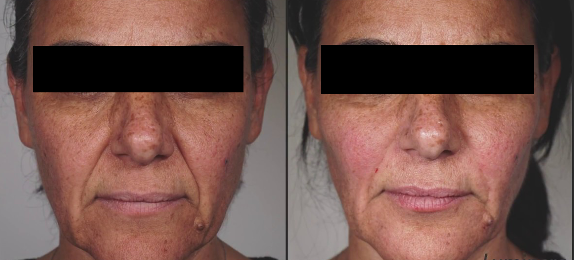 Cheek and nasolabial filler before and after: natural midface restoration and smoother smile lines with expert dermal fillers at NewLife Aesthetics, Raynes Park & Wimbledon, London.