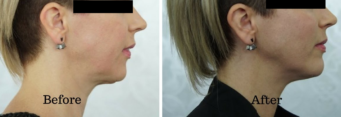 Injectable jawline fillers before and after: enhanced jaw contour, definition, and improved lower face profile following expert dermal filler treatment at NewLife Aesthetics, Raynes Park & Wimbledon, London.