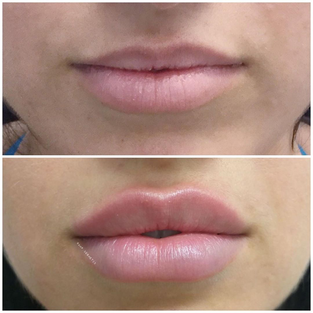 Injectable lip fillers before and after: visible natural lip enhancement, subtle volume, and improved contour after expert dermal filler at NewLife Aesthetics, Raynes Park & Wimbledon, London.