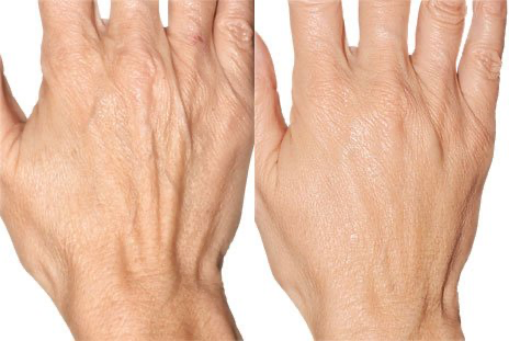 Before and after Profhilo injectable treatment for hands: increased hydration, smoother skin, minimized crepiness, and younger appearance—gallery results at NewLife Aesthetics, Raynes Park & Wimbledon, London.