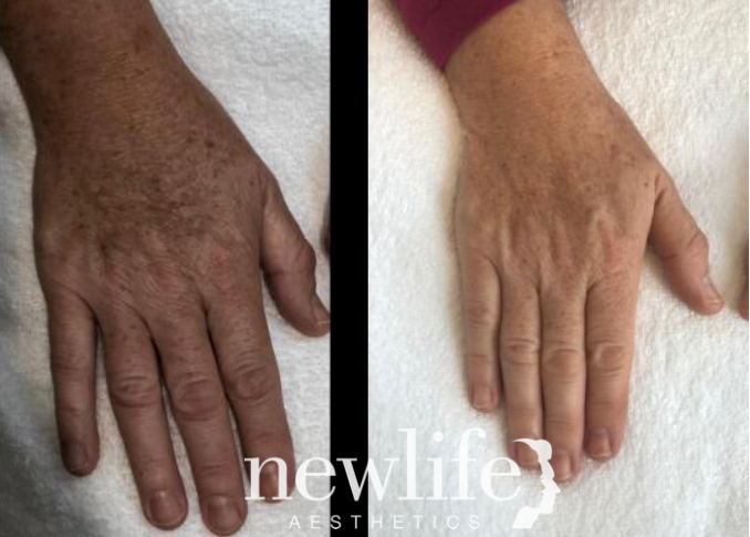 Before and after results: laser pigmentation and age spot removal for sun-damaged hands by NewLife Aesthetics, Raynes Park & Wimbledon, London—clear, youthful skin achieved.