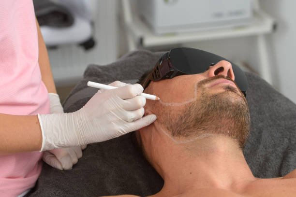 Male beard/jawline laser hair removal procedure—clinician maps beard shape before safe, effective permanent hair reduction at NewLife Aesthetics, Raynes Park & Wimbledon, London.