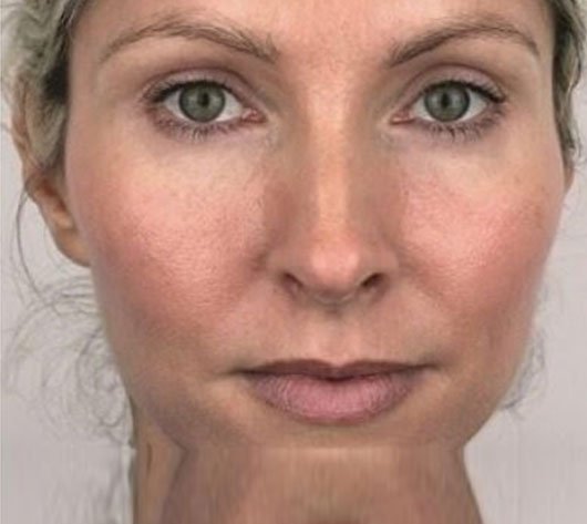 Profhilo-after2-treatment-image1