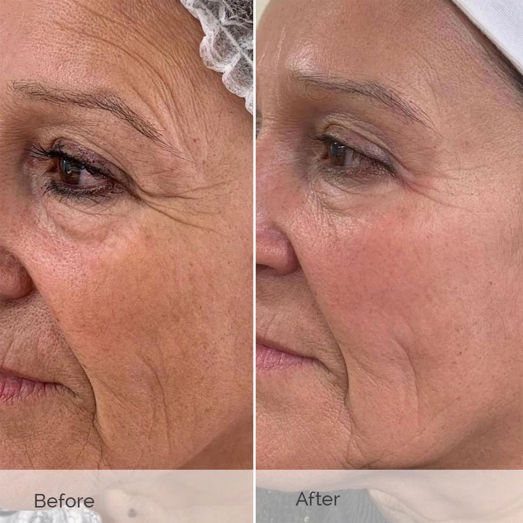 Close-up before and after Profhilo injectable: significant facial wrinkle reduction, firmer skin, and enhanced luminosity—real patient gallery at NewLife Aesthetics, Raynes Park & Wimbledon, London.