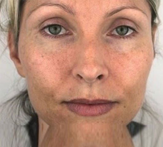 Profhilo-before2-treatment-image1