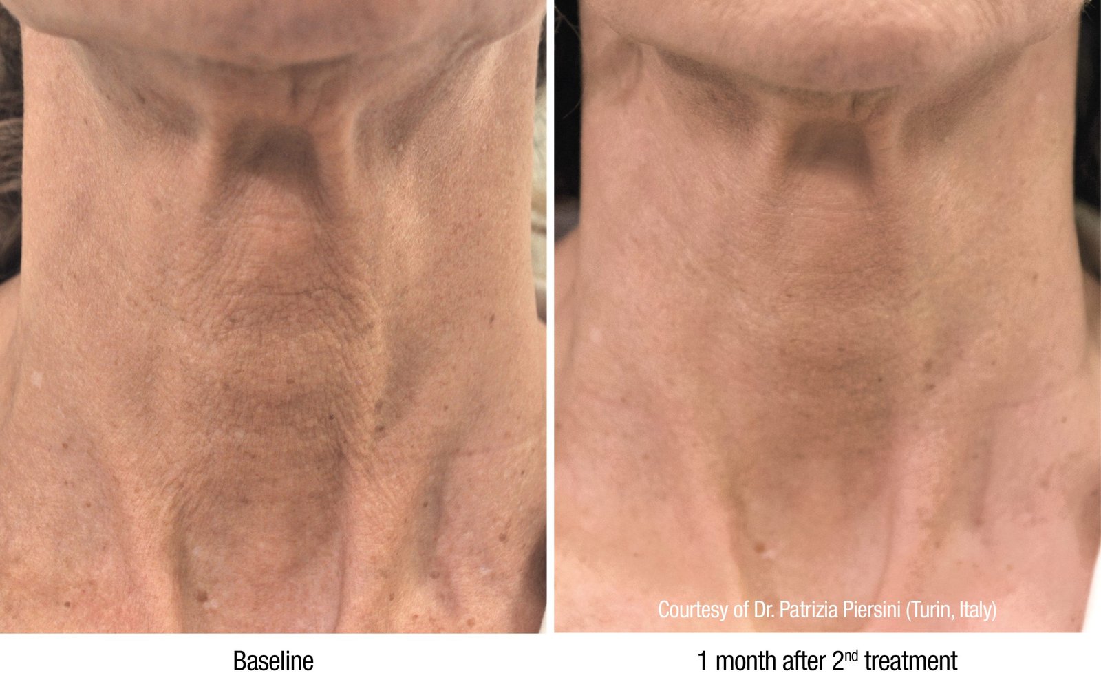 Before and after Profhilo skin booster for neck: dramatic tightening, improved crepe skin, and natural rejuvenation—gallery proof at NewLife Aesthetics, Raynes Park & Wimbledon, London.