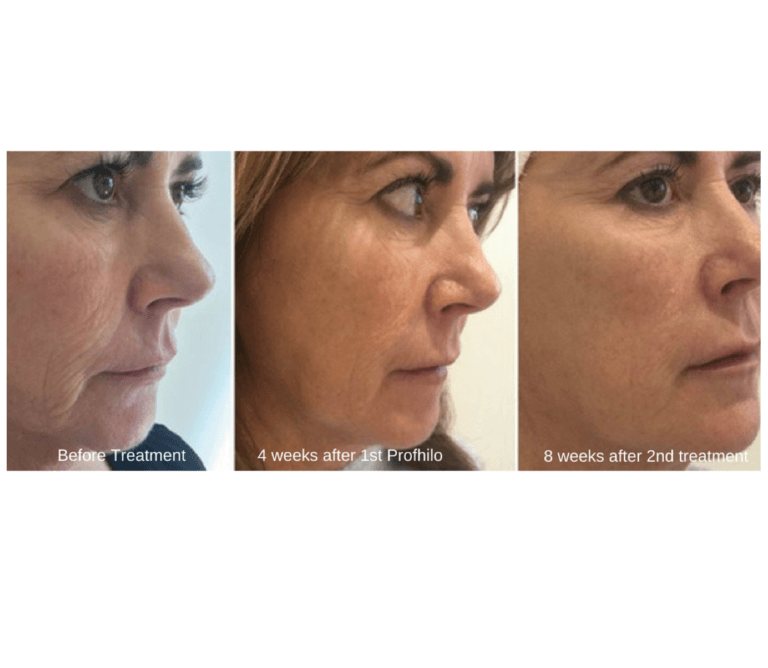 Before and after gallery: Profhilo and polynucleotide injectable skin booster for total face, hand, neck rejuvenation—improved elasticity, tone, and hydration results at NewLife Aesthetics, Raynes Park & Wimbledon, London.