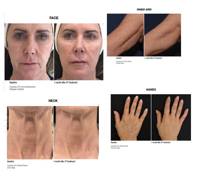 Profhilo and Polynucleotide injectable skin boosters—before and after gallery for face, inner arms, neck, and hands: improved skin texture, hydration, and firmness at NewLife Aesthetics, Raynes Park & Wimbledon, London.