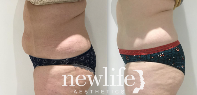 Female abdomen before and after non-surgical fat freezing (cryolipolysis), cavitation, and shockwave: visible inch loss and smoother contour—NewLife Aesthetics, Raynes Park & Wimbledon, London.