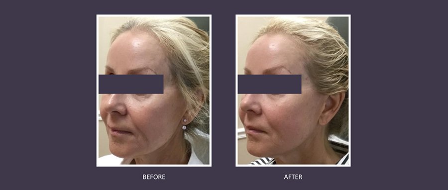Sylfirm X RF microneedling before and after: female profile view highlights lifted jawline, firmer skin, improved texture, and lighter pigmentation—treatment at NewLife Aesthetics, Raynes Park & Wimbledon, London.