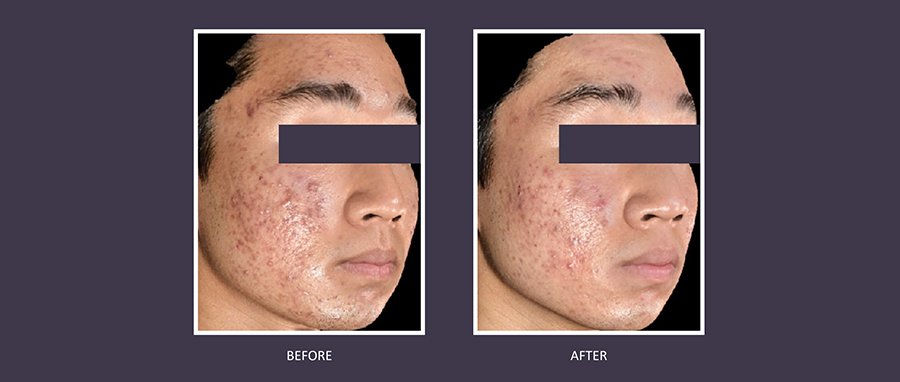 Sylfirm X RF microneedling before and after: jawline, lower face skin tightening, and dramatic pigment reduction—real patient results at NewLife Aesthetics, Raynes Park & Wimbledon, London.