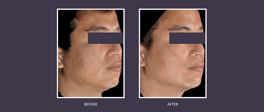 Sylfirm X RF microneedling before and after: jawline skin tightening, reduced pigmentation and acne scarring—gallery results at NewLife Aesthetics, Raynes Park & Wimbledon, London.