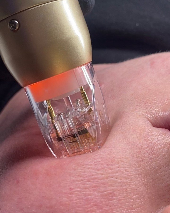 Close-up macro of Sylfirm X RF microneedling: gold-plated insulated needles delivering energy for collagen induction and facial tightening, performed by NewLife Aesthetics, Raynes Park & Wimbledon, London.