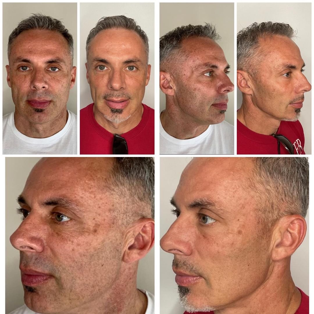 Sylfirm X RF microneedling male gallery: multi-angle before and after—skin tightening, improved texture, and visible rejuvenation from non-surgical facial RF at NewLife Aesthetics, Raynes Park & Wimbledon, London.