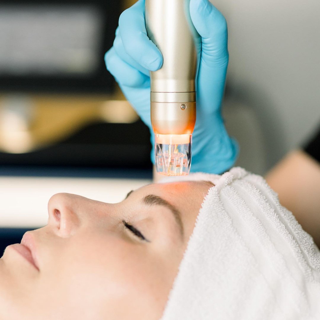 Sylfirm X RF microneedling facial treatment in progress—clinician using dual-wave device on patient’s cheek for anti-wrinkle, tightening, and rejuvenation benefits at NewLife Aesthetics, Raynes Park & Wimbledon, London.