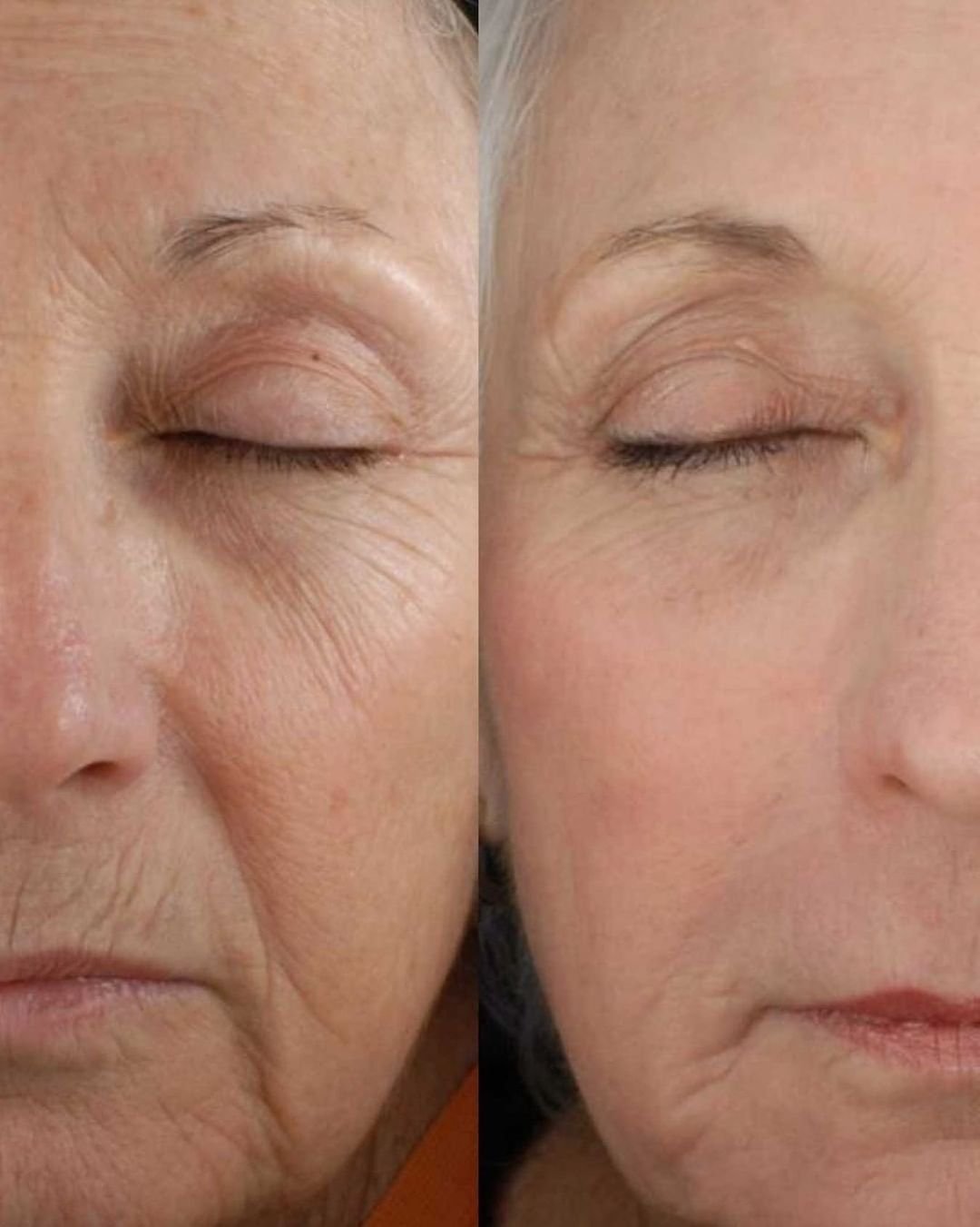 Split photo: before and after Sylfirm X RF microneedling—dramatic reduction of under-eye and crow’s feet wrinkles, smoother skin texture, and brightened eye area at NewLife Aesthetics, Raynes Park & Wimbledon, London.