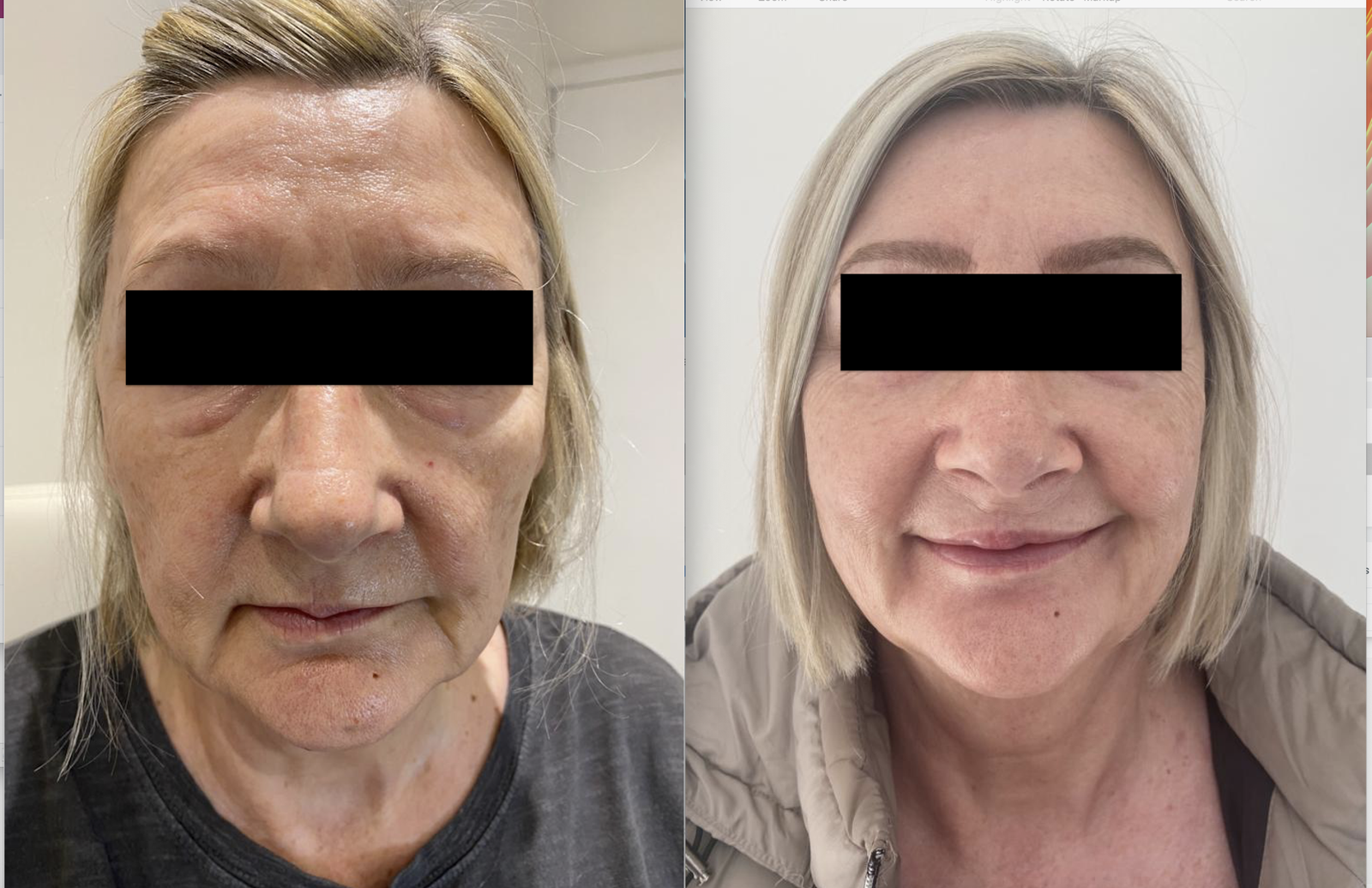 Before and after Sylfirm X RF microneedling: facial transformation with visibly firmer skin, smoother texture, and reduced wrinkles—real patient gallery, NewLife Aesthetics, Raynes Park & Wimbledon, London.