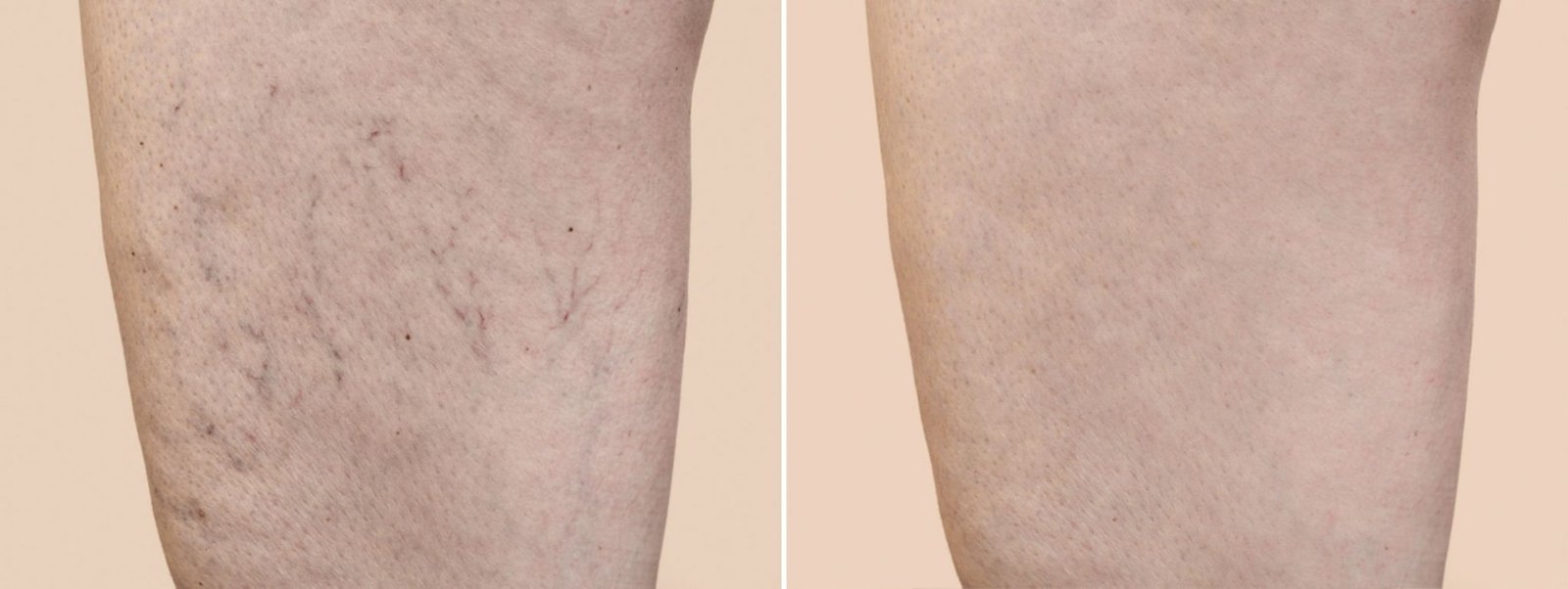 Before and after results of laser leg vein removal for visible spider veins and thread veins—NewLife Aesthetics, Raynes Park & Wimbledon, London. Clear, vein-free skin achieved.