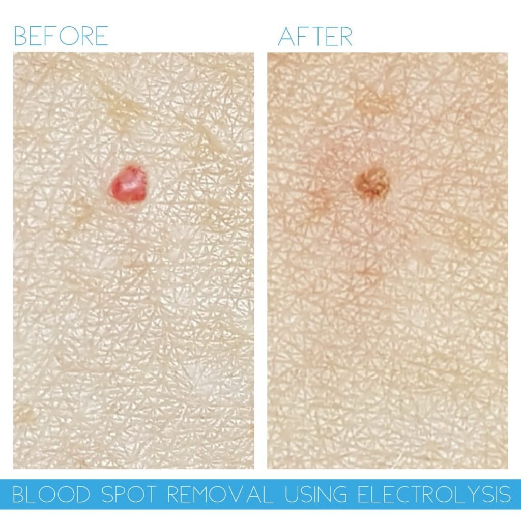 blood-spot-removal-electrolysis-before-after-skin-blemish-raynes-park-wimbledon-london