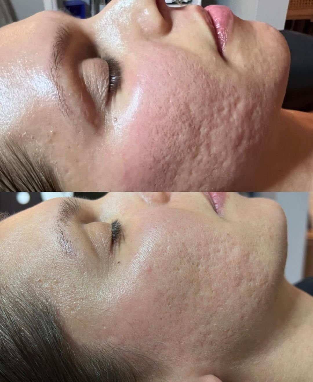 Microneedling, face of a woman before and after treatment