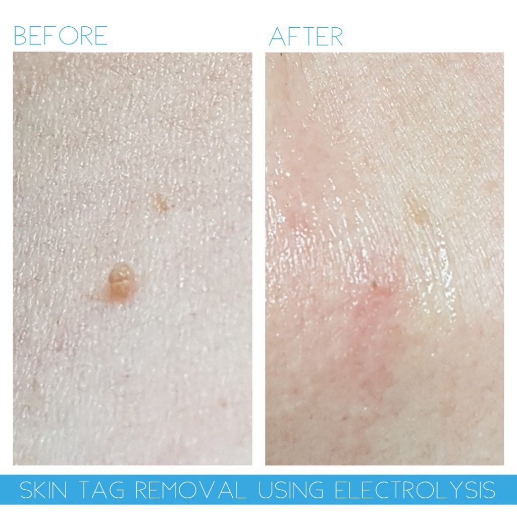 Before and after skin tag removal using advanced electrolysis at NewLife Aesthetics, Raynes Park, Wimbledon, London—showing clear skin results.
