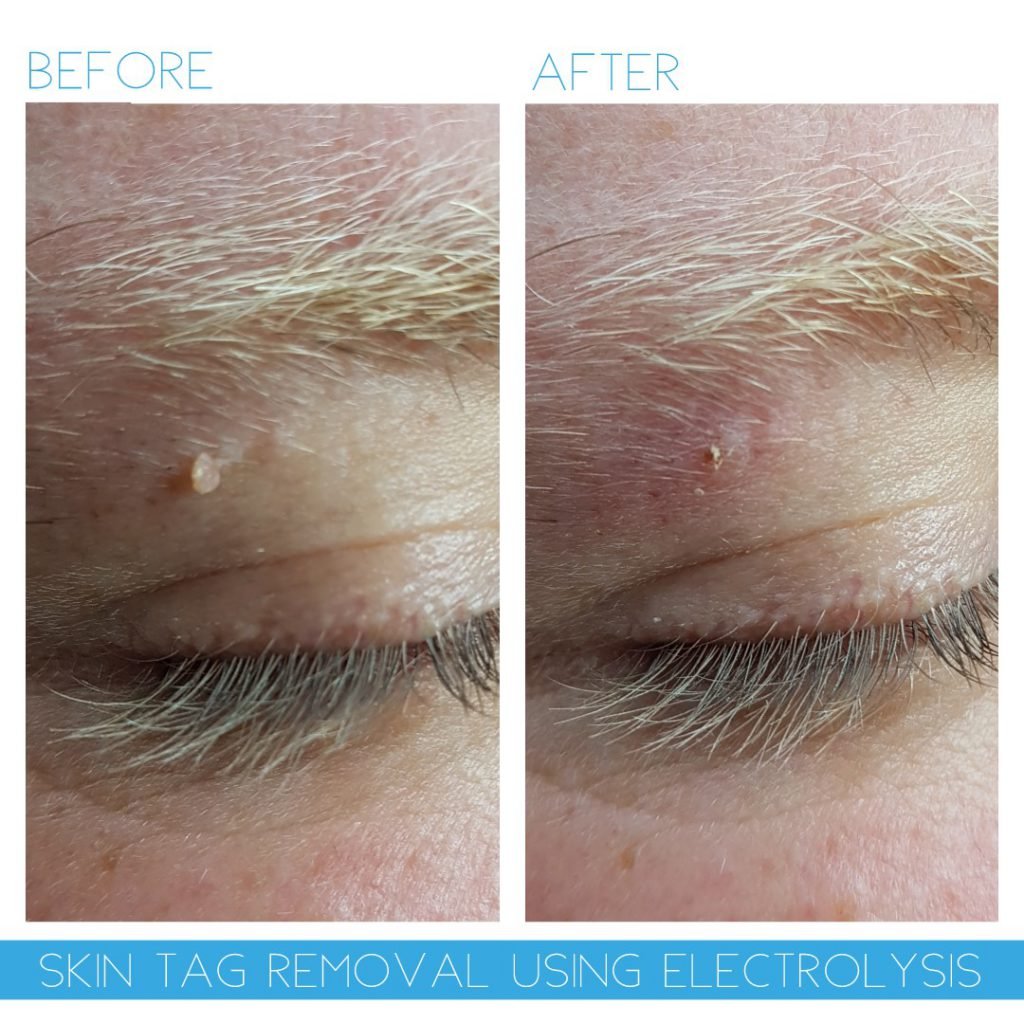 Before and after results of thread vein removal using electrolysis at NewLife Aesthetics, showing clear skin improvement for Raynes Park & Wimbledon, London.