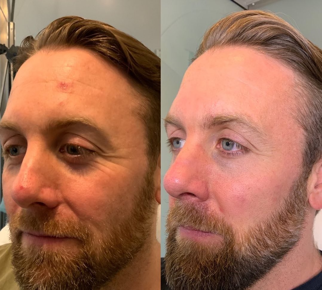 chemical peel before and after man treatment
