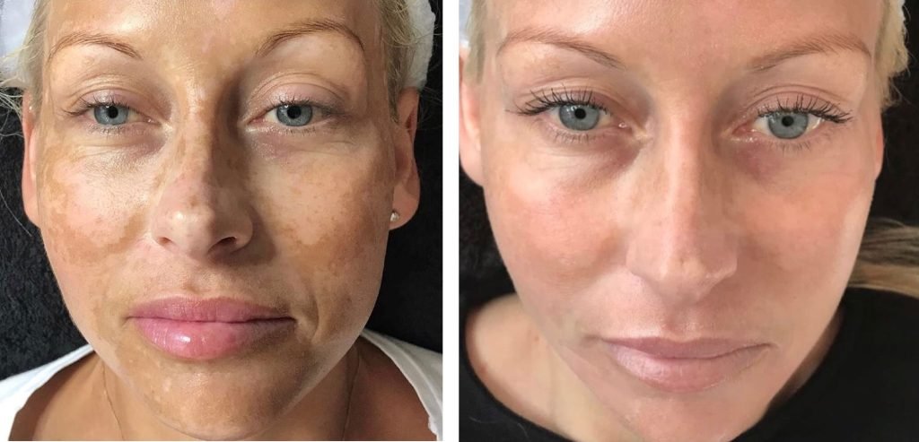 Before and after Cosmelan treatment showing improved skin tone and reduced pigmentation on female face