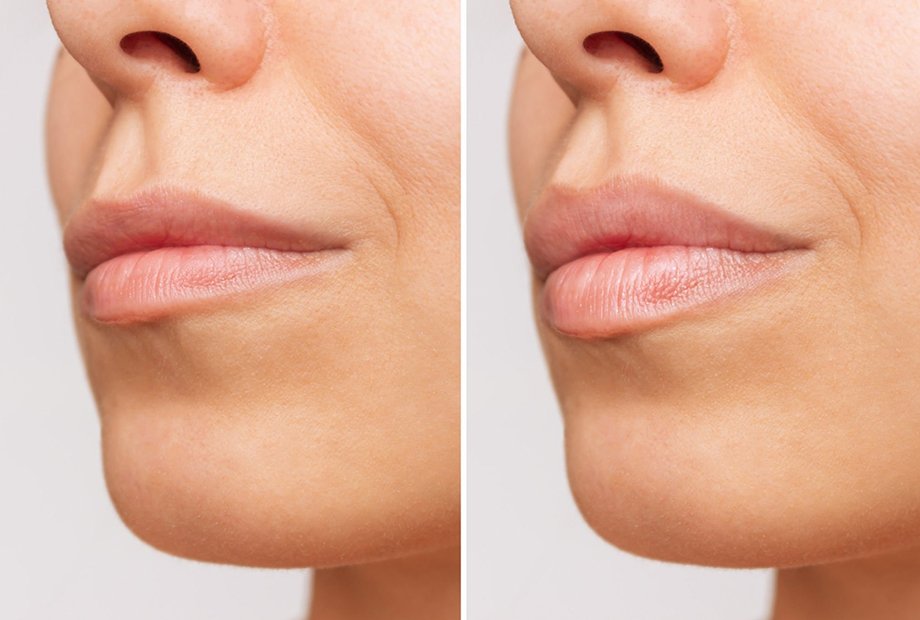 Lip filler before and after – expert lip enhancement at Wimbledon & Raynes Park aesthetic clinic, natural volume and contour results