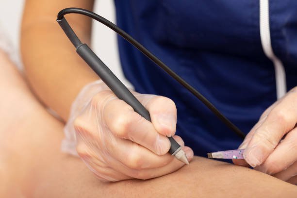 Professional electrolysis needle hair removal procedure on leg at NewLife Aesthetics, Raynes Park & Wimbledon, London—precise permanent hair reduction for smooth skin.