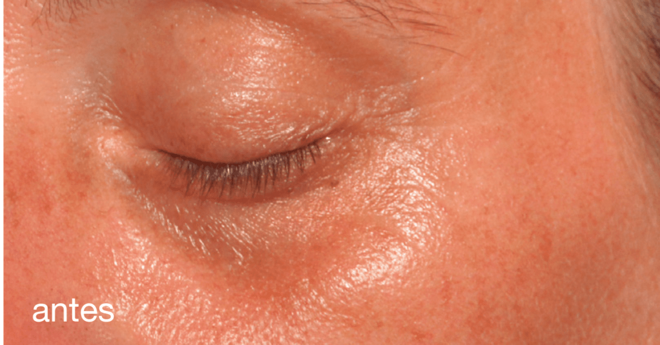 Under-eye before Global Eyecon treatment: pigmentation, dark circles, and fine lines, NewLife Aesthetics, Raynes Park & Wimbledon, London