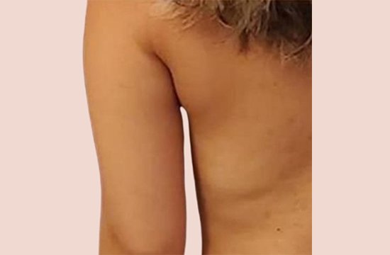 fat freezing after 4 AFTER