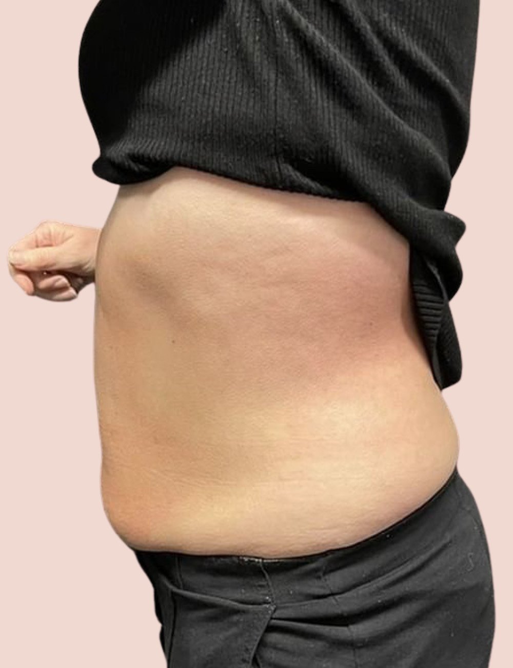 fat freezing after 6