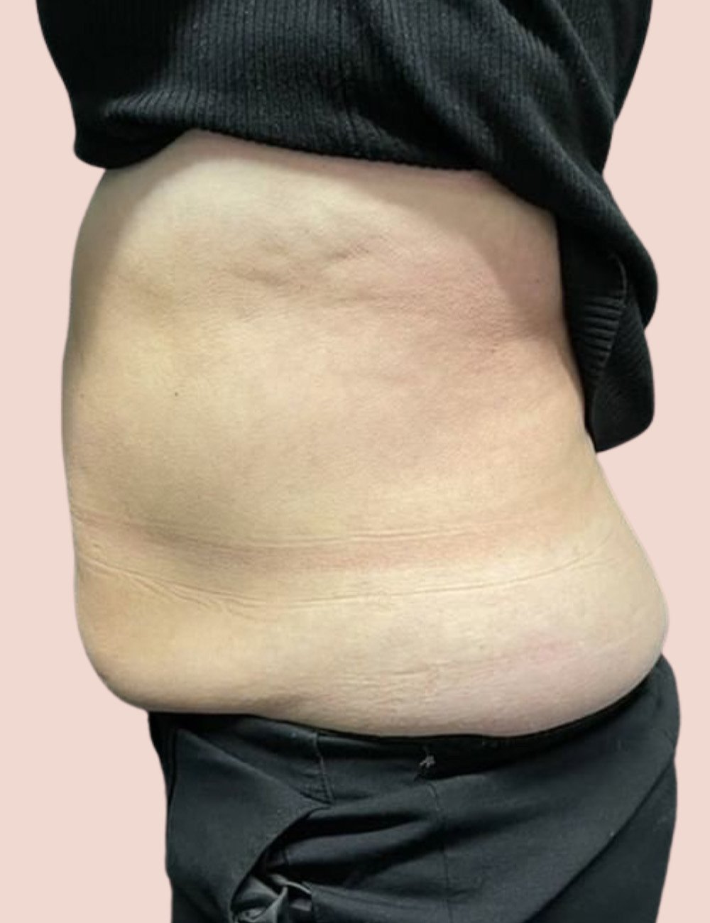 fat freezing before 5