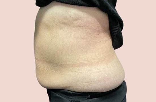 fat freezing before 6 BEFORE