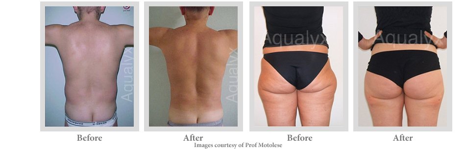 Multi-patient before and after results of Aqualyx fat dissolving injections showing fat reduction in lower back, flanks, and buttocks at NewLife Aesthetics, serving Raynes Park & Wimbledon, London.