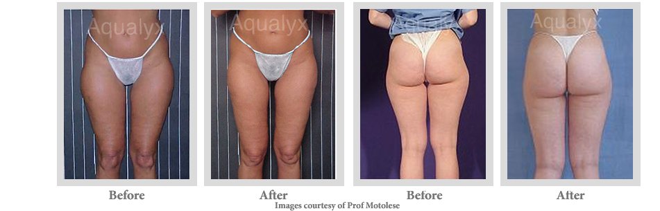 Before and after photos showing improved lower body and hip contour after AQUALYX fat dissolving treatment