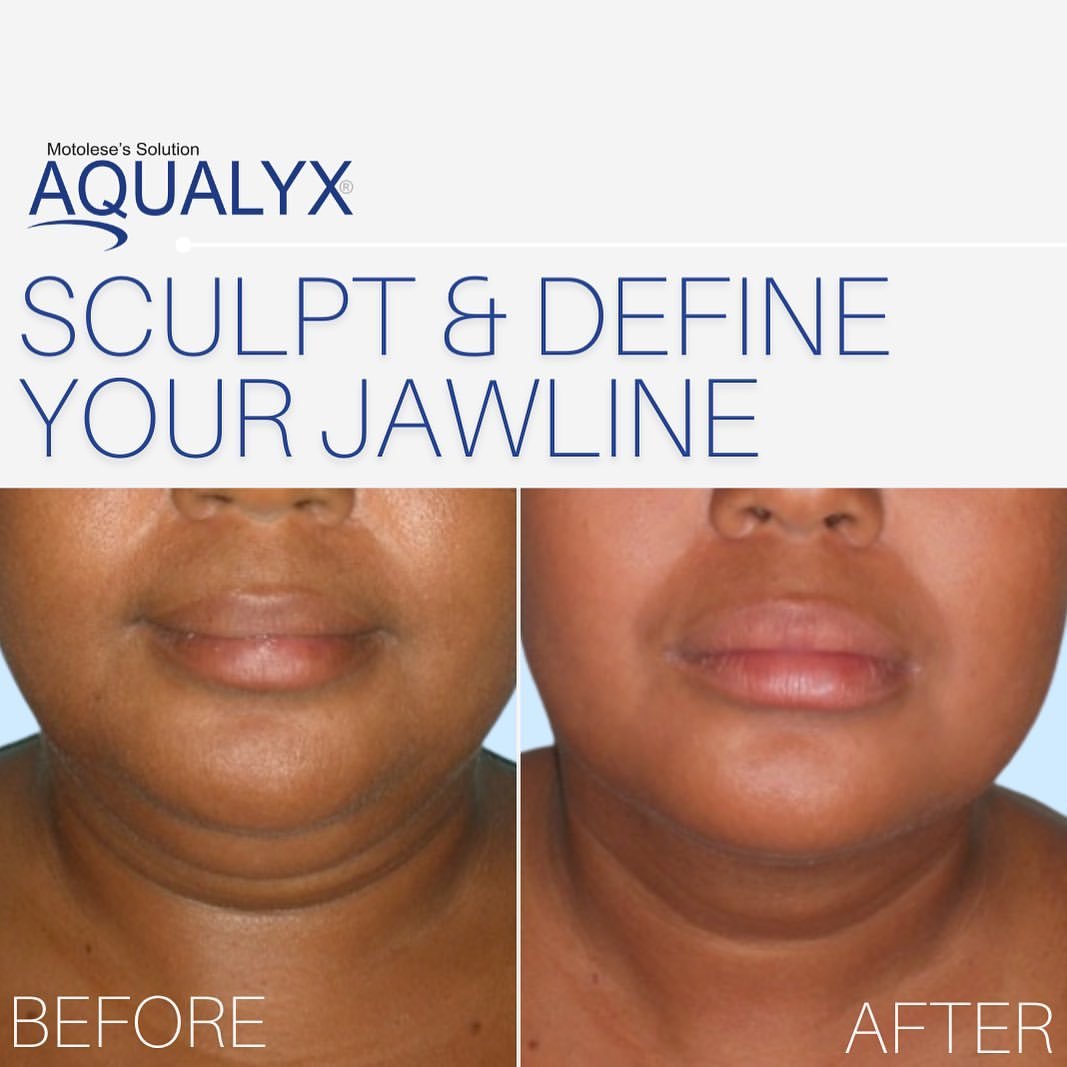 Before and after results of fat dissolving injections showing reduced double chin and improved jawline definition