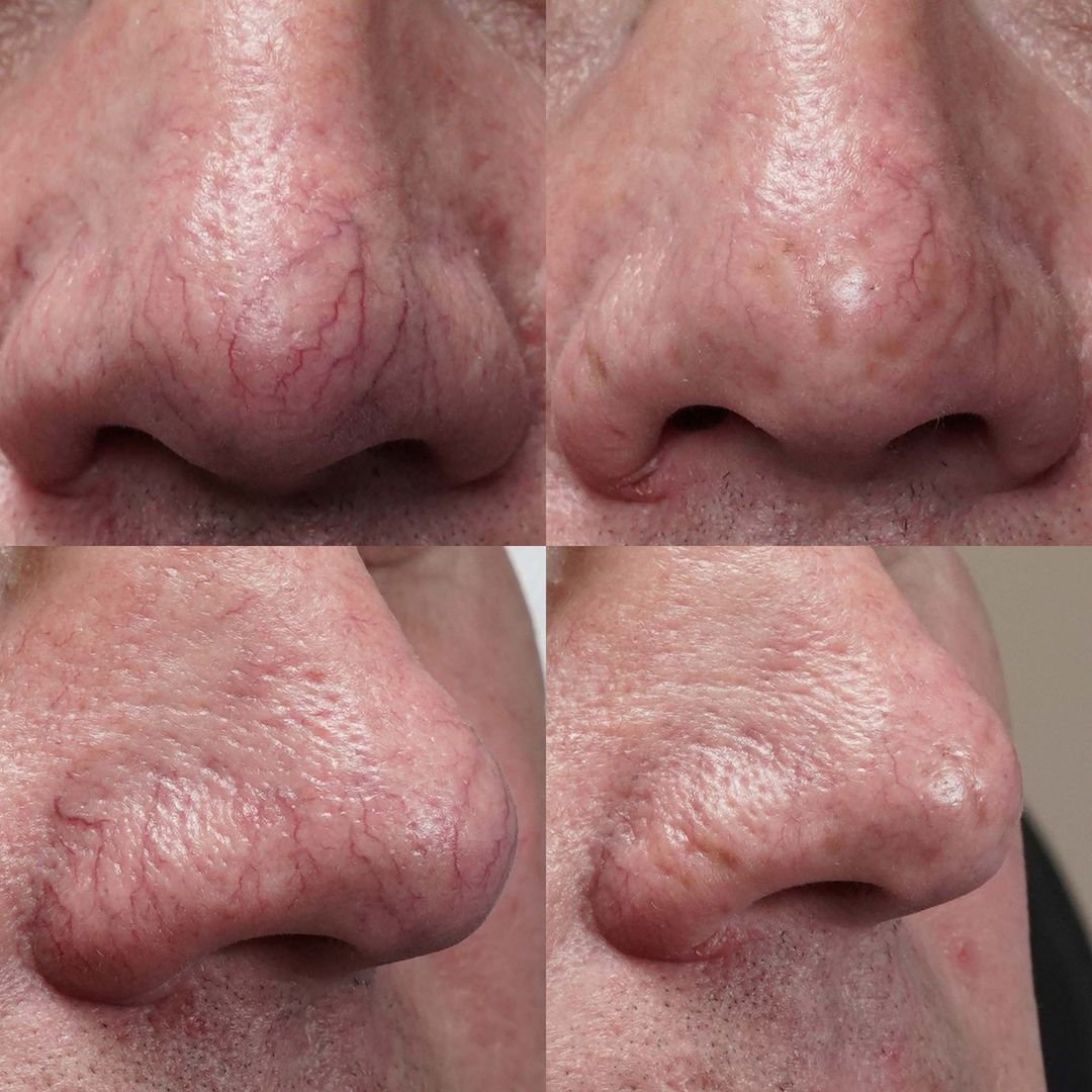 veins on nose, laser vein removal on a man