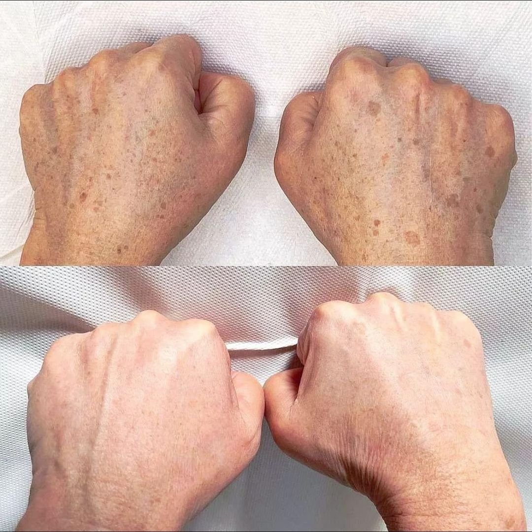 Before and after results: laser hand rejuvenation treating pigmentation, sun damage, veins, and age spots—delivering clearer, younger-looking hands at NewLife Aesthetics, Raynes Park & Wimbledon, London.