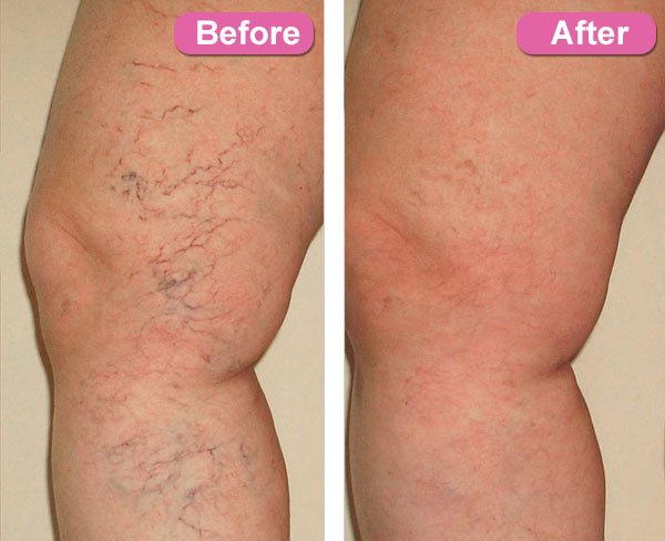 Before and after close-up of leg showing results of laser vein removal treatment